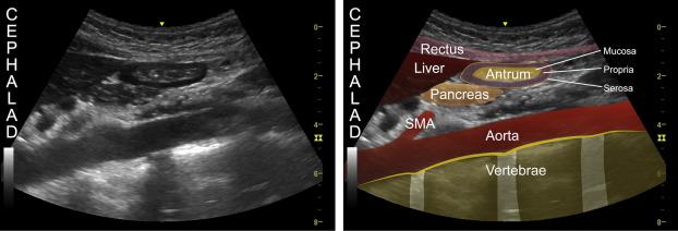 Gastric Ultrasound